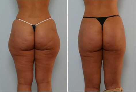 Cirugía de Liposucción: Antes y después